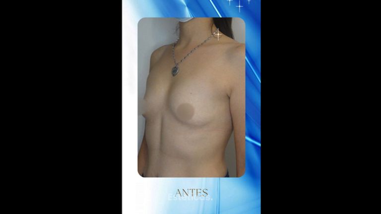 Aumento mamas - Dr. Rodolfo Villavicencio