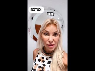 Botox - Dra. Anahi Versace