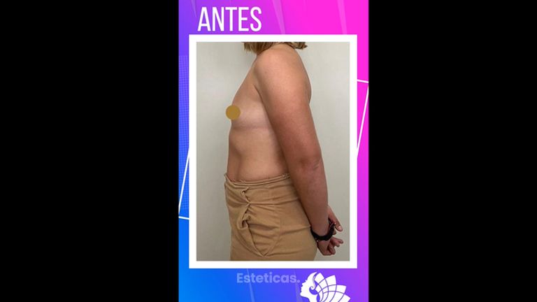 Aumento mamas - Dr. Emmanuel Manavela Chiapero