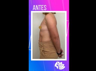 Aumento mamas - Dr. Emmanuel Manavela Chiapero