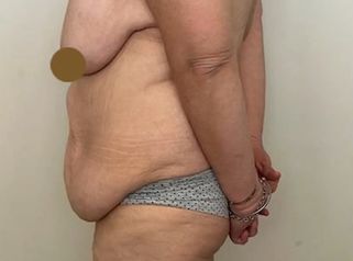 Lipoescultura - Dr. Emmanuel Manavela Chiapero