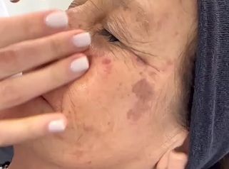Pigmentacion facial - Dra. Maria Lucchesi Medicina Estetica