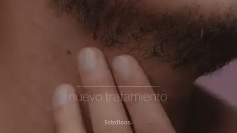 Rellenos Faciales - Dra. Jimena D. Frasso