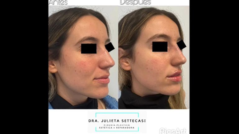 Relleno de labios +  Rinomodelación - Dra. Julieta Settecasi