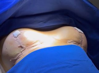 Mastopexia - Dr. Rodolfo Villavicencio
