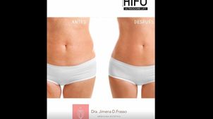 Aplicaciones del HIFU Aplicaciones del HIFU