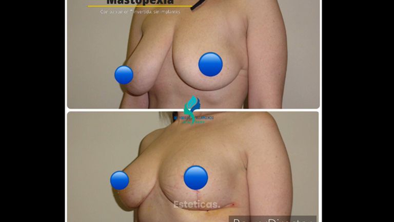 Mastopexia - Dr. Rodolfo Villavicencio