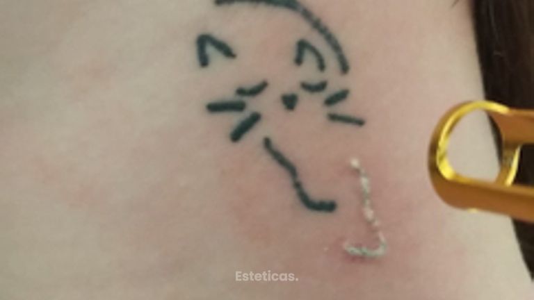 Borrar tatuaje - Dr. Alejandro Leone