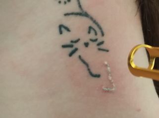 Borrar tatuaje - Dr. Alejandro Leone