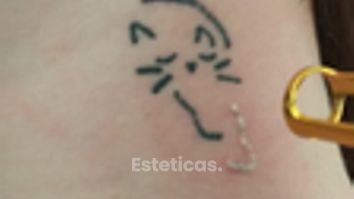 Borrar tatuaje - Dr. Alejandro Leone