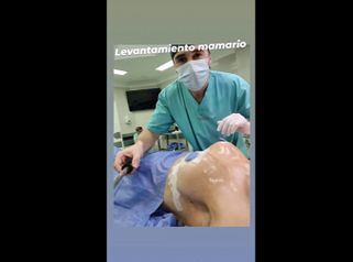 Levantamento mamario - Dr. Damián Galeazzo y Equipo