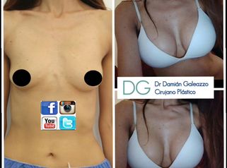Dr. Galeazzo: Aumento mamario