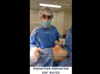 Aumento mamas - Dr. Damián Galeazzo y Equipo