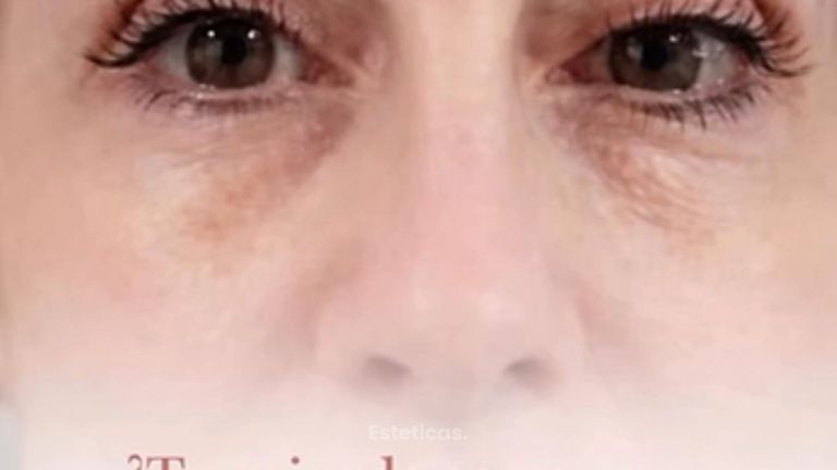 Blefaroplastia sin cirugía - Dra. Jimena D. Frasso