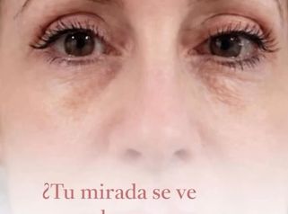 Blefaroplastia sin cirugía - Dra. Jimena D. Frasso