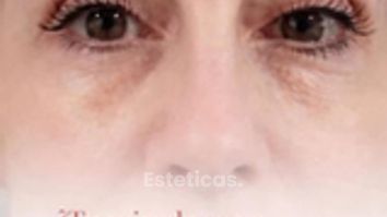 Blefaroplastia sin cirugía - Dra. Jimena D. Frasso