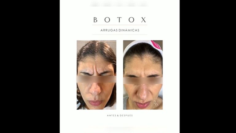 Dra. Romina Neira - Botox