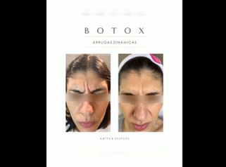 Dra. Romina Neira - Botox