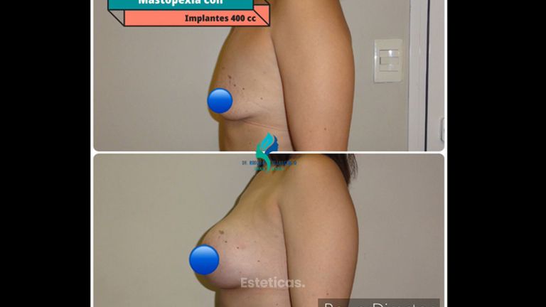 Mastopexia - Dr. Rodolfo Villavicencio