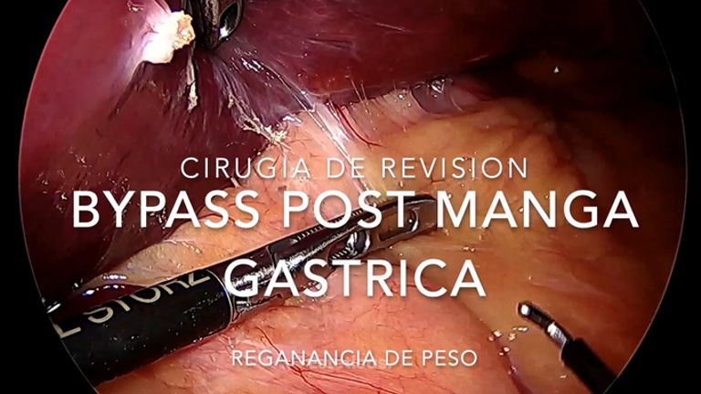 Bypass gástrico