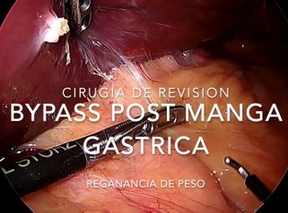 Bypass gástrico 