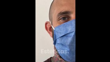 Otoplastia - Dr. Hugo Ayarde