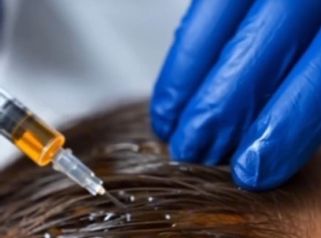 ¿Se te cae el pelo más de lo normal? - Dr. Jose Luis Ava