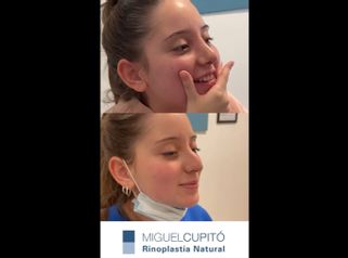 Rinoplastia - Dr. Miguel Ángel Cupito