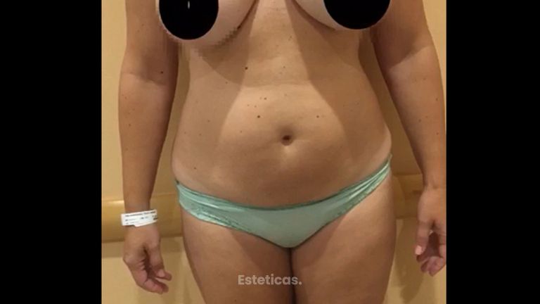 Lipoescultura