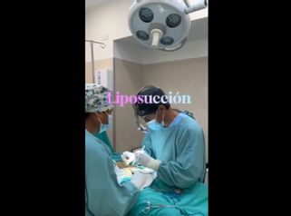 Liposucción - Dr. Diego Cunille