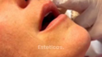 Relleno de labios - Dr. Agustín Matia