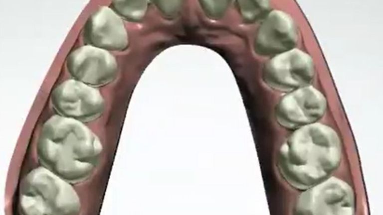 Ortodoncia no Bracks