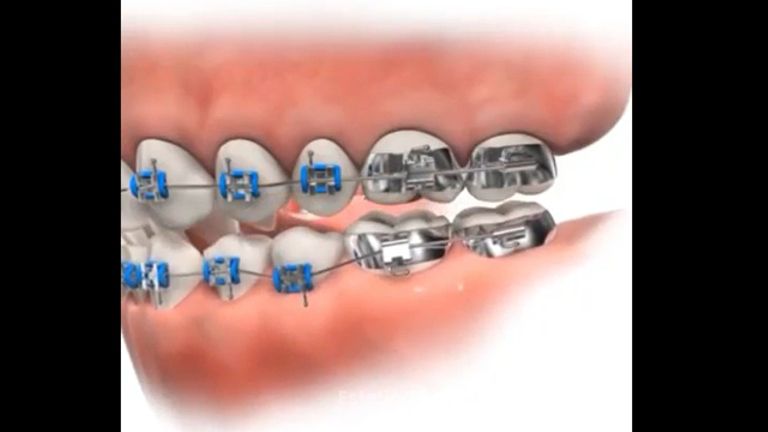 Ortodoncia - Dental Advance