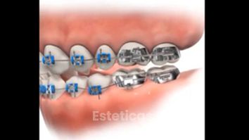 Ortodoncia - Dental Advance