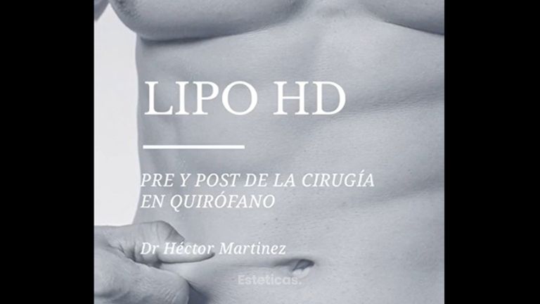 Liposucción HD - Dr. Héctor Martínez Gomez