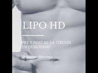 Liposucción HD - Dr. Héctor Martínez Gomez