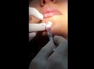 Relleno de labios - Dra. Cristina G. Lazarte