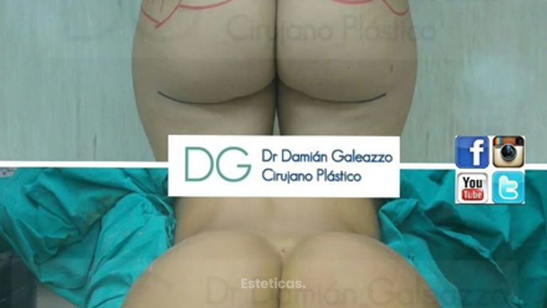 Gluteoplastías.