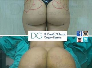 Gluteoplastías.
