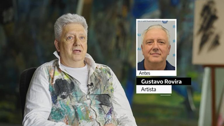 Implante capilar - Experiencia de Gustavo en Medical Hair