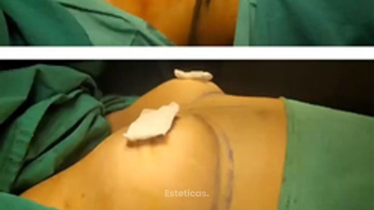 Aumento mamas - Dr. Walter Gabriel Huck - Centro Médico Alvear