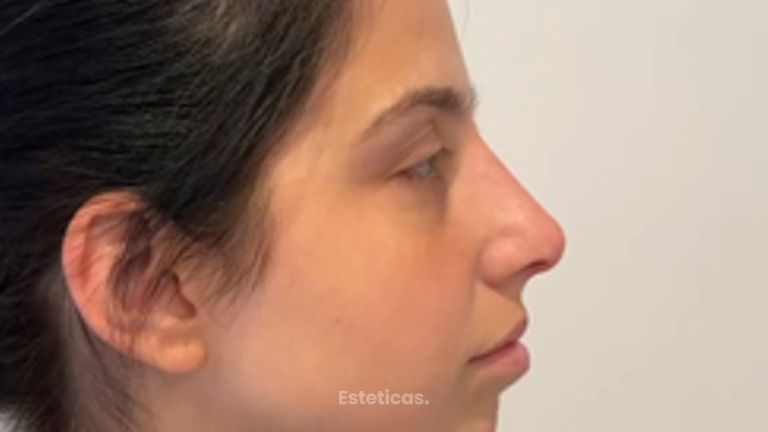 Rinoplastia - Dr. Fernando Glaria