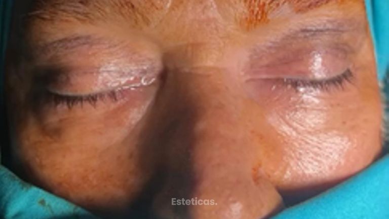 Blefaroplastia - Dra. María Victoria Rodríguez