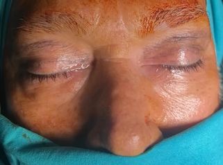 Blefaroplastia - Dra. María Victoria Rodríguez