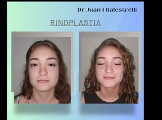 Rinoplastia - Dr. Juan Ignacio Balestrelli