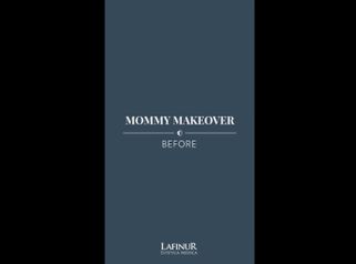 Mommy makeover - Dr. Federico Coccaro