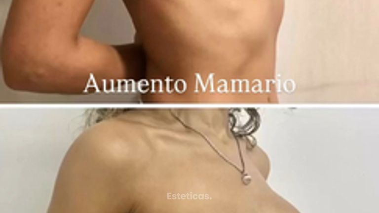 Aumento Mamas - Dra. María de la Paz Vélez