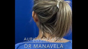 Auriculoplastia - Dr. Emmanuel Manavela Chiapero