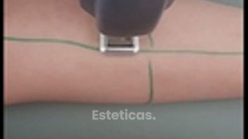 Depilación Laser Leda con escanear rápido en 15 minutos