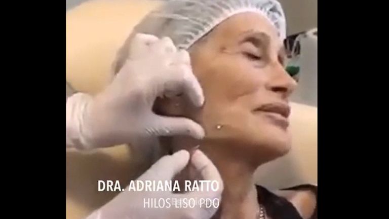 Hilos tensores faciales - Dra. Adriana Ratto